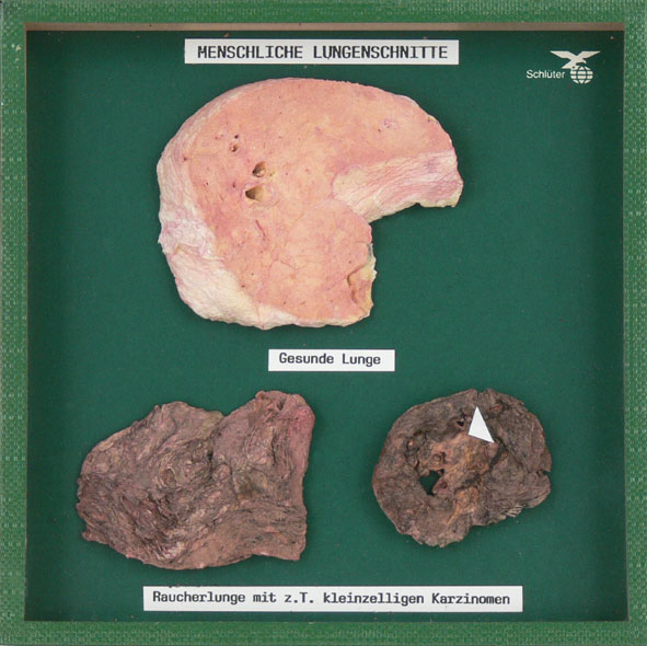 Smoker's lung