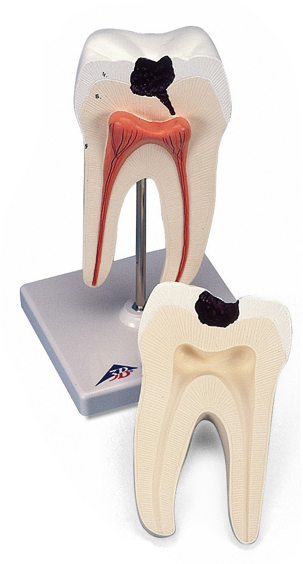 MOD: Lower Twin-Root Molar