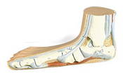 Mod. Flat foot (Pes Planus)