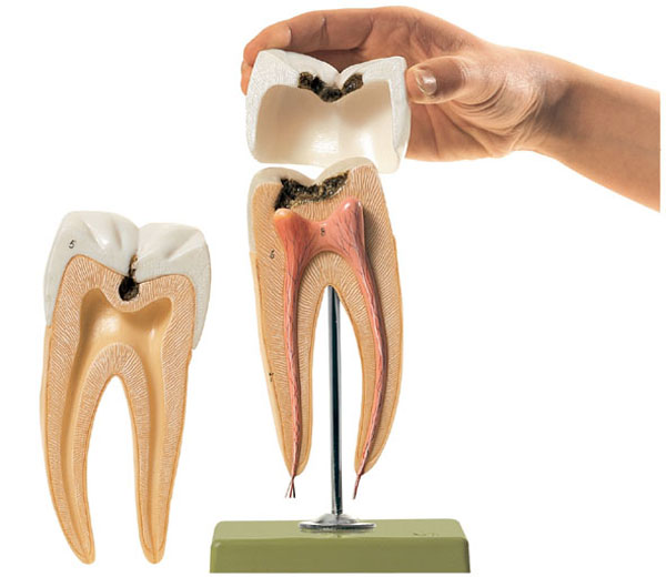 Molar tooth with caries