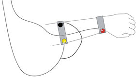 Electromyogram (EMG)